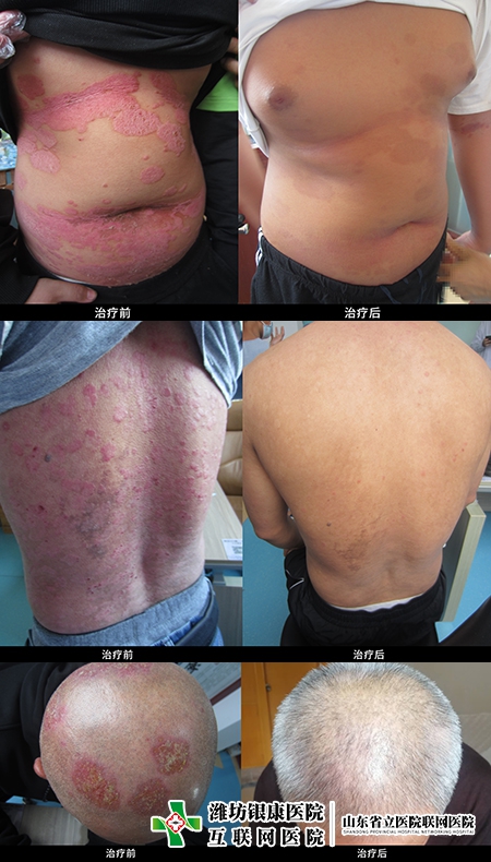 銀屑病研究院銀屑病康復(fù)案例 銀屑病研究院銀屑病康復(fù)案例