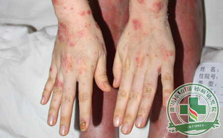 銀屑病預(yù)防
