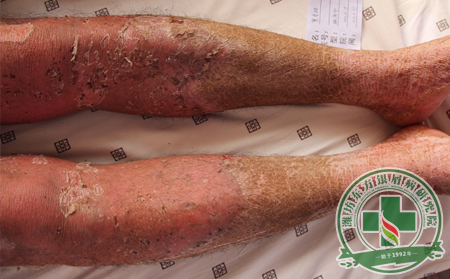 銀屑病預(yù)防