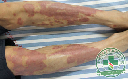 生活中要如何降低銀屑病發(fā)病率