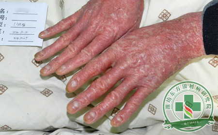 關(guān)節(jié)型銀屑病