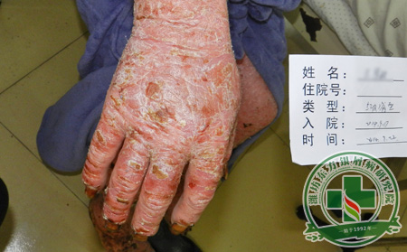 關(guān)節(jié)型銀屑病