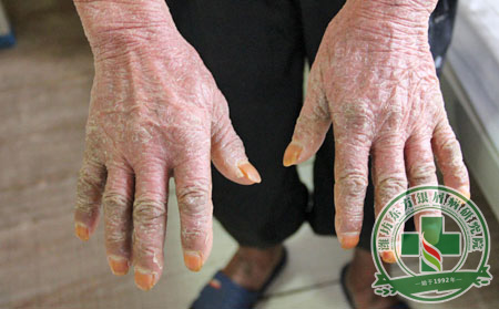 關(guān)節(jié)型銀屑病