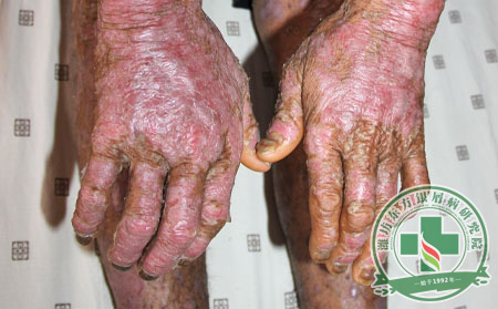 關(guān)節(jié)型銀屑病