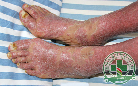 關(guān)節(jié)型銀屑病