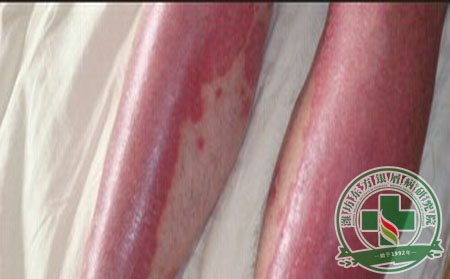 為什么會(huì)患紅皮型銀屑病