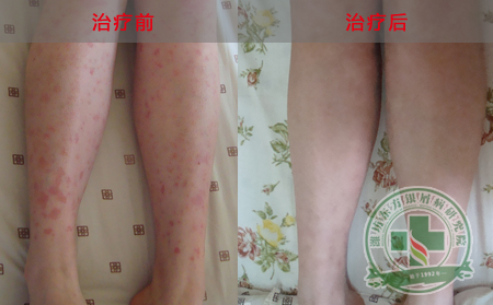 關節(jié)型銀屑病