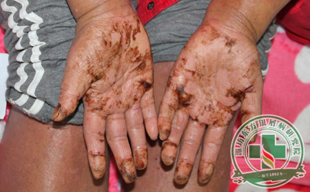 關(guān)節(jié)病性銀屑病反復(fù)發(fā)作的病因