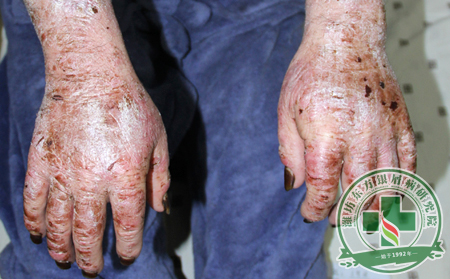 治療關(guān)節(jié)病型銀屑病理想方法