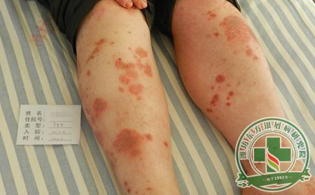 女性銀屑病的致病因素有哪些?