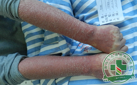 什么樣的女性容易患有銀屑病疾??？