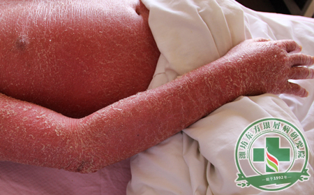 紅皮型銀屑病