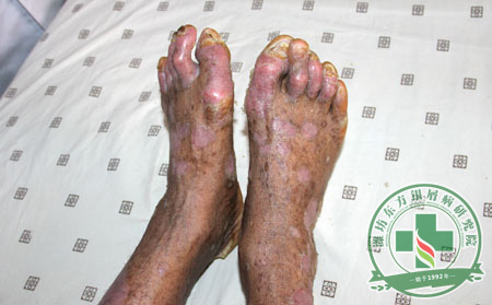 后天里如何預(yù)防銀屑病遺傳