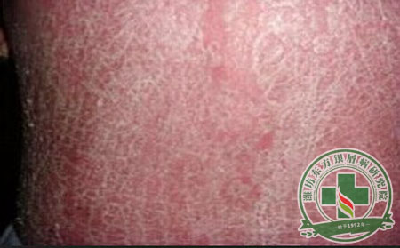 紅皮型銀屑病有什么表現(xiàn)