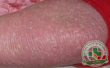 生活中怎樣預(yù)防紅皮型銀屑病