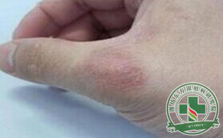 雙手紅皮病型銀屑病有什么病因