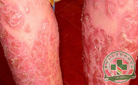 紅皮型銀屑病預(yù)防重點(diǎn)