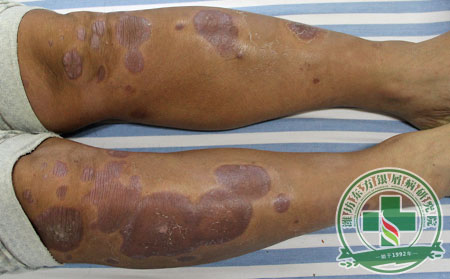 銀屑病遺傳下一代嗎