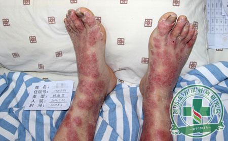 銀屑病注意事項有什么