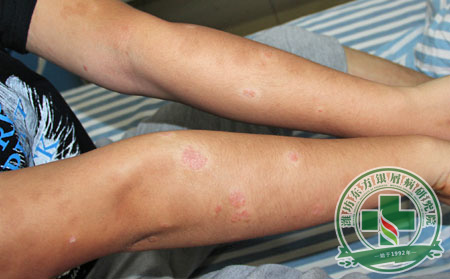 銀屑病是遺傳病嗎