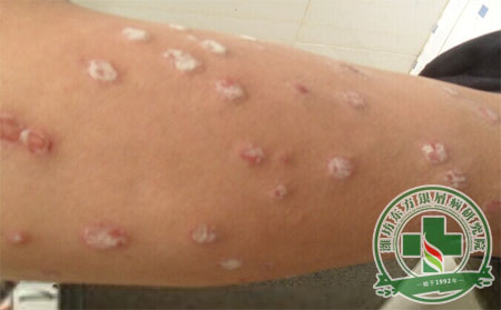 銀屑病平時注意什么