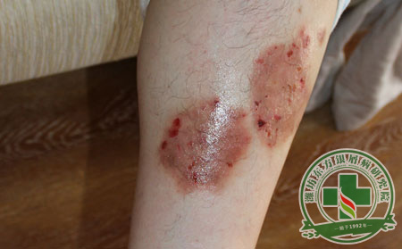 銀屑病有沒有傳染