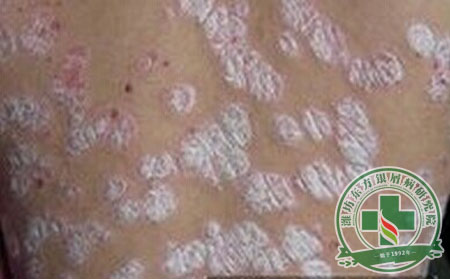 銀屑病應(yīng)該注意哪些