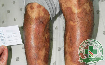 銀屑病的并發(fā)癥具體是些什么