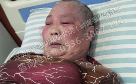 入院時(shí)局部皮膚情況