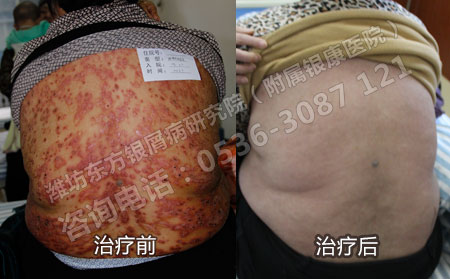 病情穩(wěn)定后