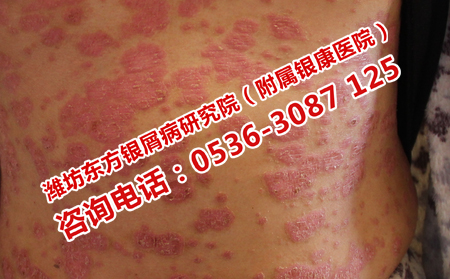 濰坊哪家醫(yī)院治療牛皮癬效果專業(yè)