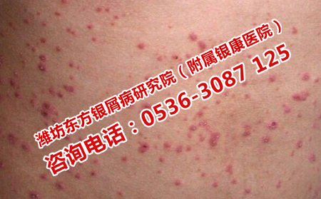 治療牛皮癬實(shí)力強(qiáng)的醫(yī)院