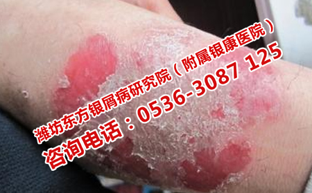 銀屑病恢復(fù)慢的原因