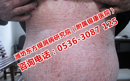 牛皮癬復(fù)發(fā)的原因是哪些