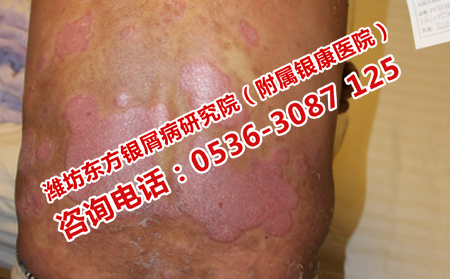 治療中牛皮癬復(fù)發(fā)怎么辦