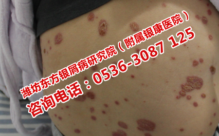 濰坊理想的銀屑病治療醫(yī)院