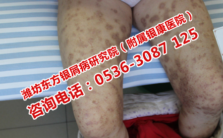 牛皮癬蔓延怎么控制理想