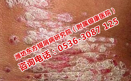 西醫(yī)治療牛皮癬的缺點(diǎn)