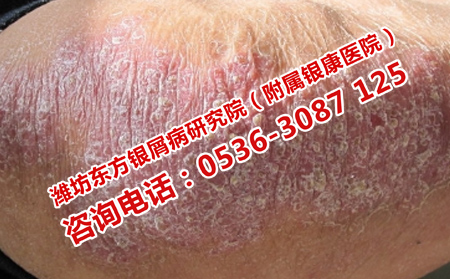 具體哪些因素導致牛皮癬