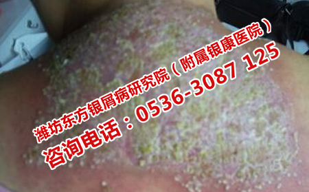 得了銀屑病該如何治療