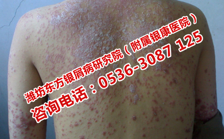 濰坊牛皮癬的方法是什么