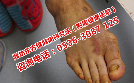 皮膚上牛皮癬治理想