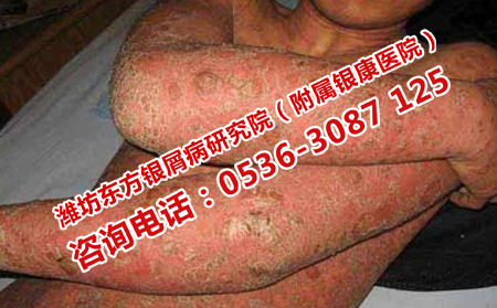 牛皮癬護(hù)理不理想有什么嚴(yán)重后果