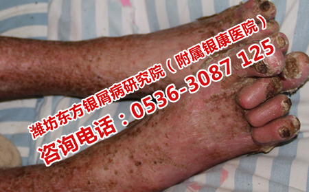 濰坊牛皮癬醫(yī)院在哪里