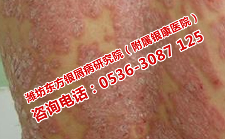 三個(gè)治療牛皮癬的誤區(qū)