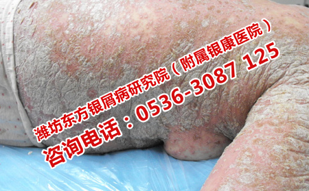 哪家醫(yī)院治牛皮癬有效