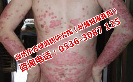 不同類型的牛皮癬應(yīng)該怎么治療呢