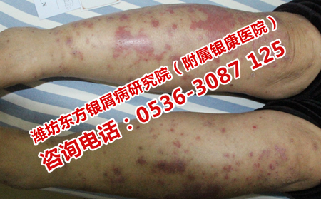 不同類型牛皮癬治療