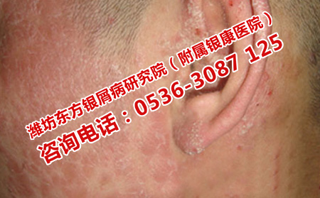 銀屑病患者清潔皮膚的原則