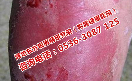 牛皮癬為什么不見理想轉(zhuǎn)